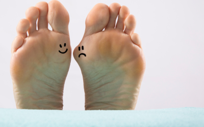 How to Prevent and Treat Bunions: Causes, Symptoms, and Non-Surgical Options